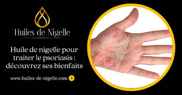zwarte komijnolie psoriasis