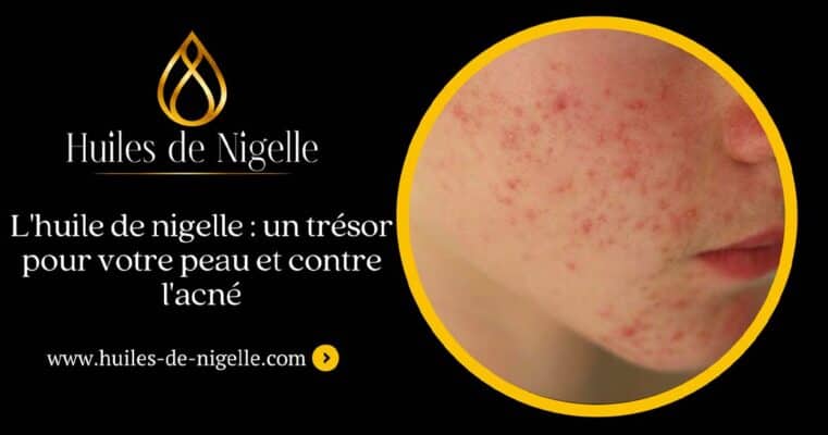 zwarte komijnolie tegen acne